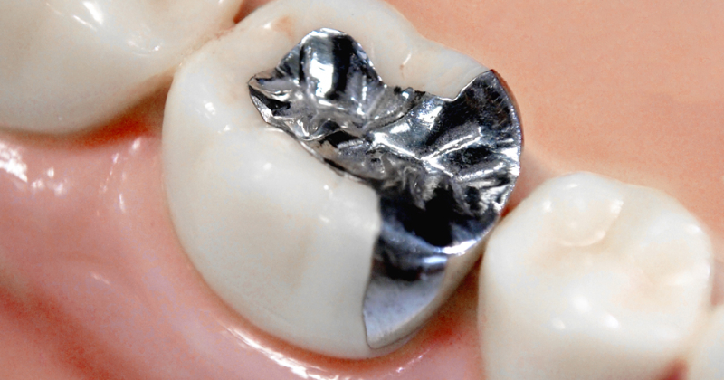 銀歯の拡大画像