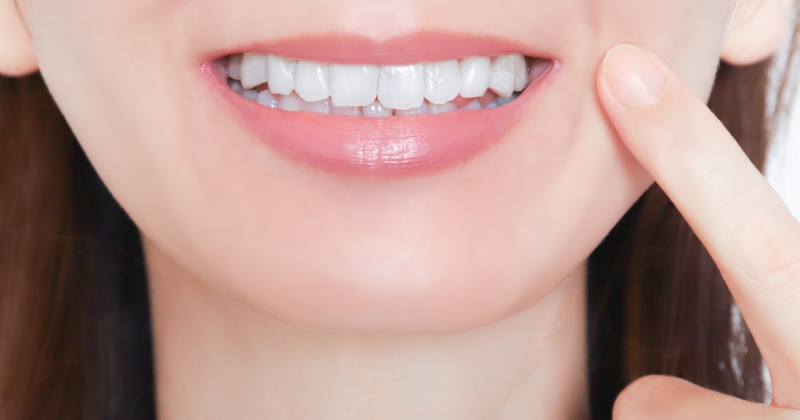 銀歯から白い詰め物に変更した笑顔の女性
