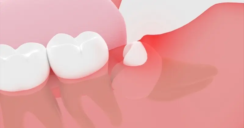 親知らずが斜めに生えて歯茎が腫れているイラスト